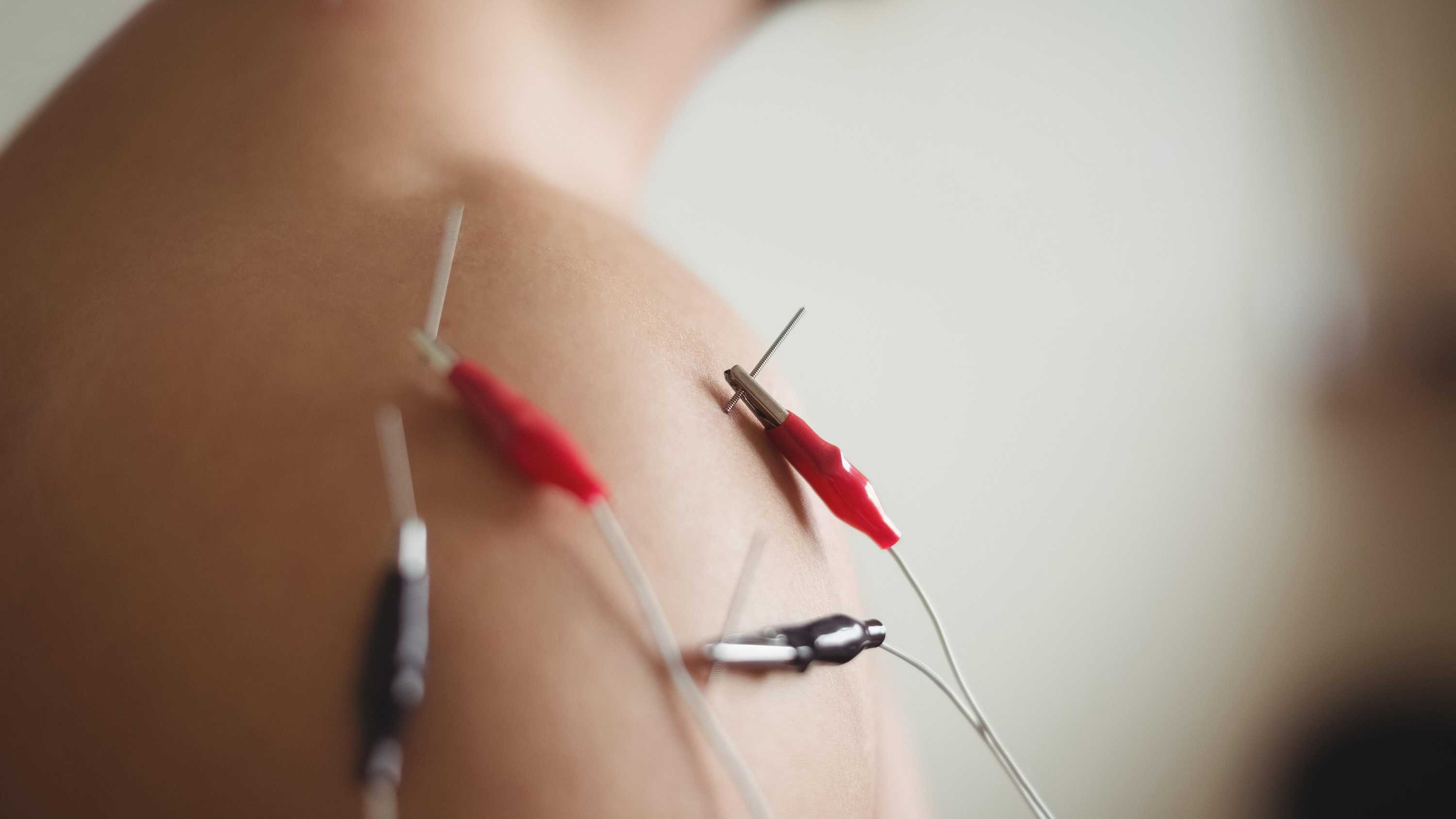 Man receiving dry needling with electrical stimulation