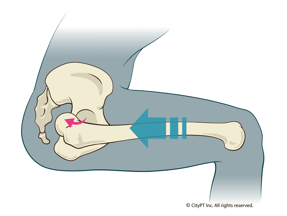 Detailed illustration of a hip dislocation