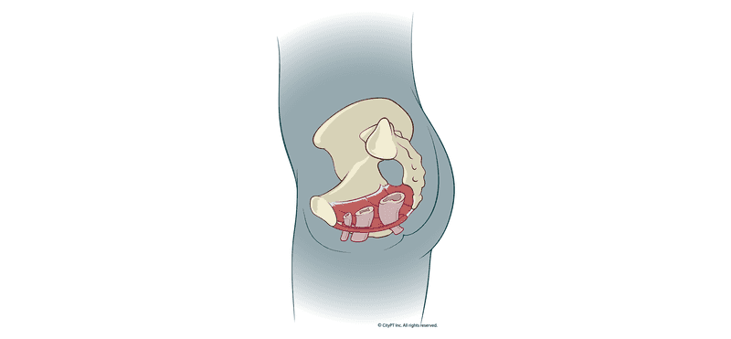 Illustration of pelvic floor dysfunction