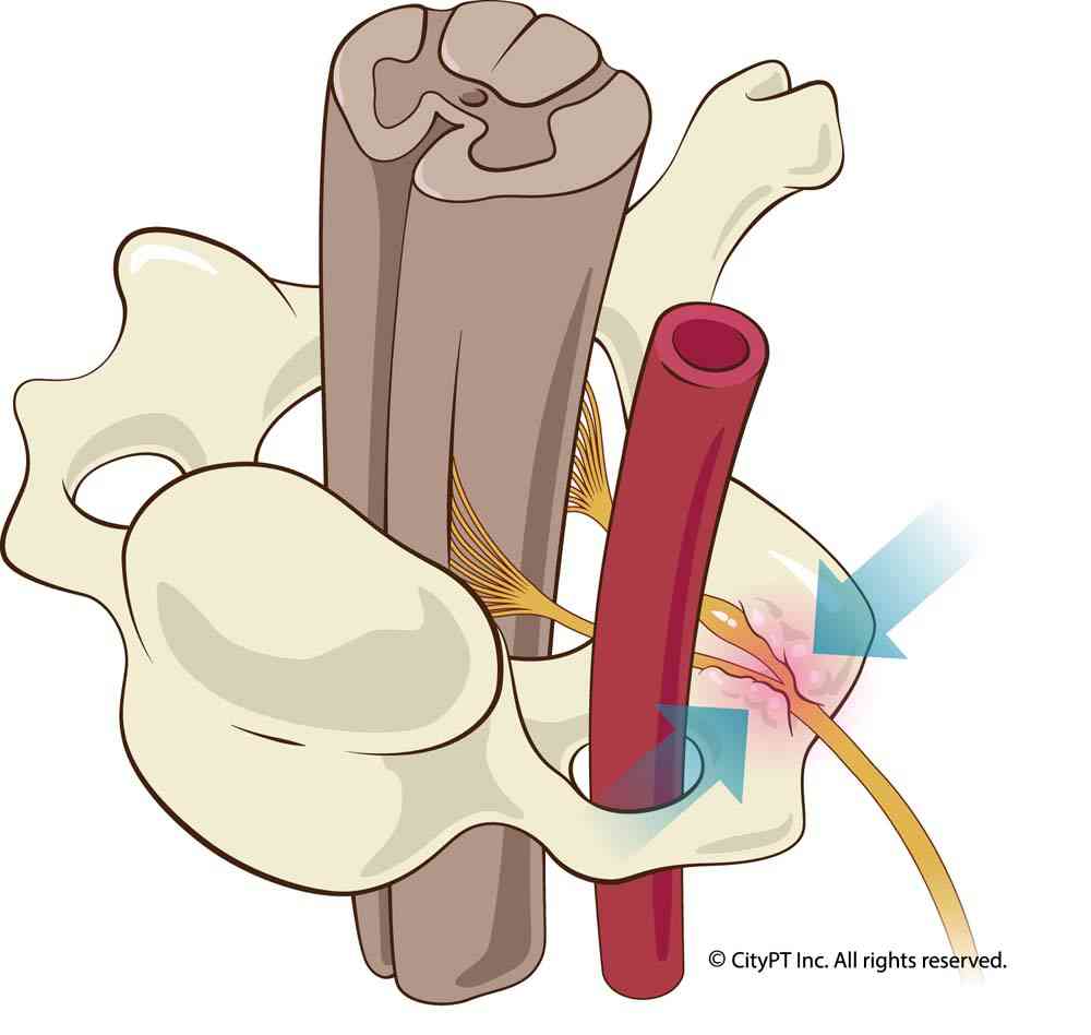 Cervical vertebra, spinal cord, and pinched nerve causing radiculopathy Illustration close-up of cervical vertebra, spinal cord, and a pinched nerve causing cervical radiculopathy