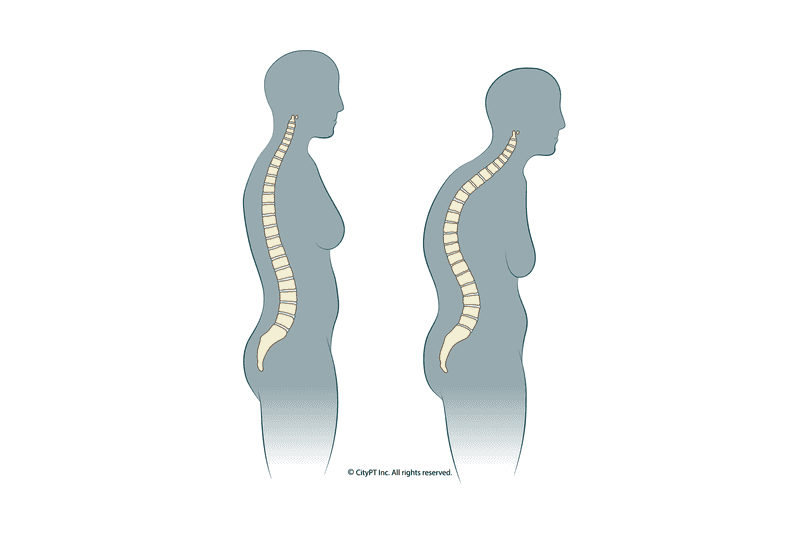 Illustration of a spine with hyperkyphosis