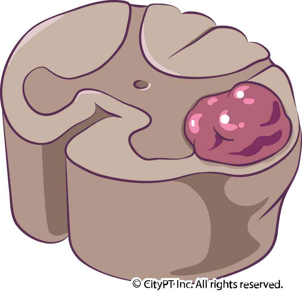 Detail of abnormal growths or masses that may occur within the spinal column Illustration of a cervical tumor