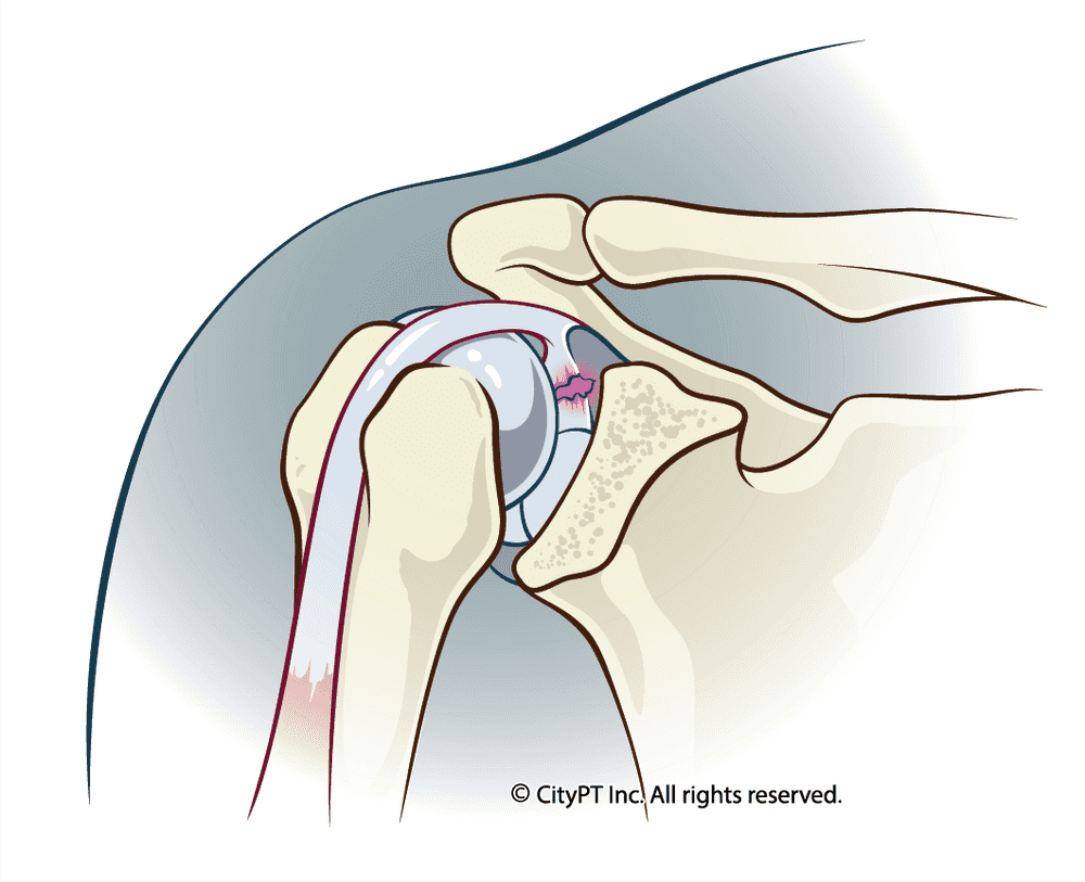 Shoulder labrum irritation, emphasizing the a tear in the labral tissue surrounding the shoulder joint Anatomical illustration of a shoulder labrum irritation
