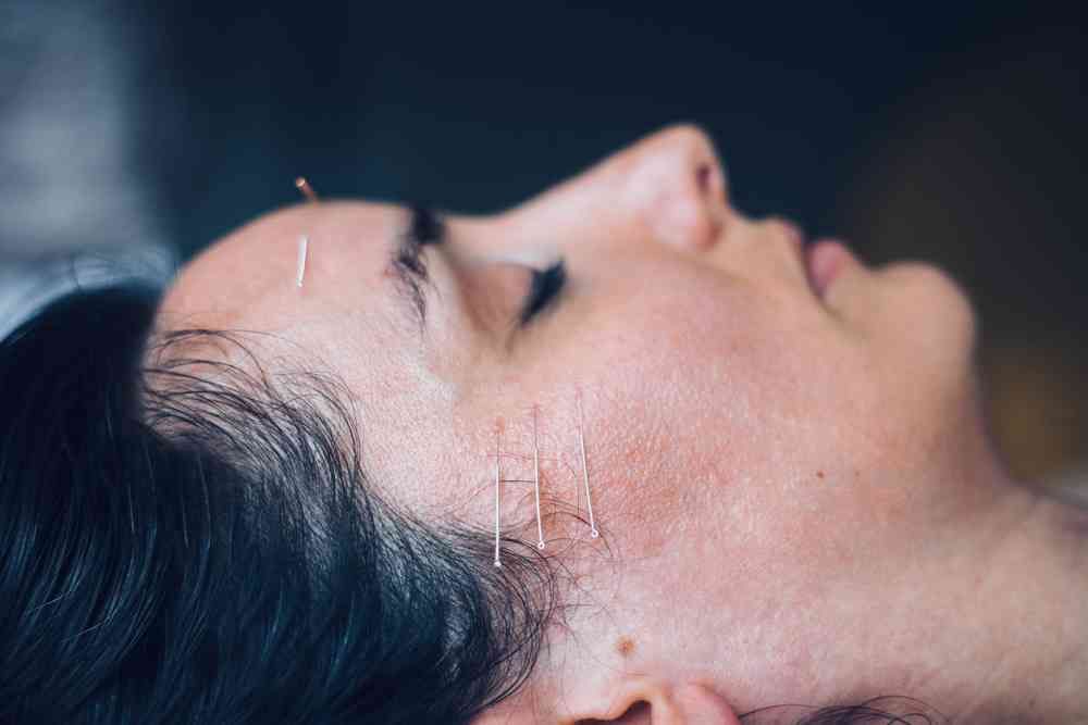 Woman undergoing acupuncture treatment for the first time