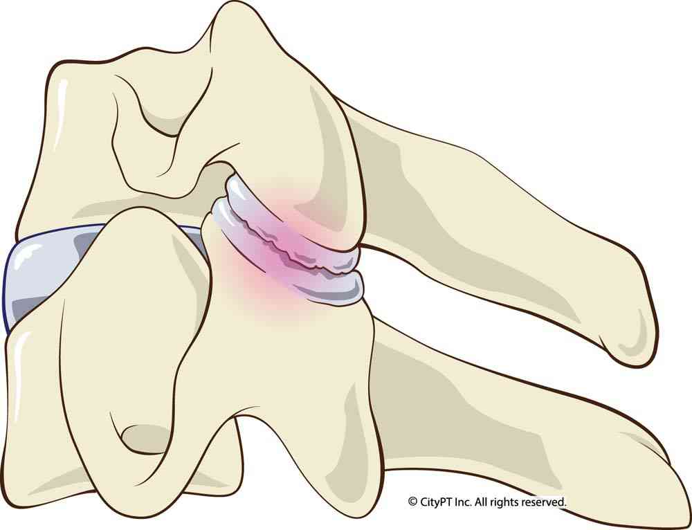 Cartilage inside facet joint breaking down and causing pain Illustration of facet joint syndrome anatomy and action