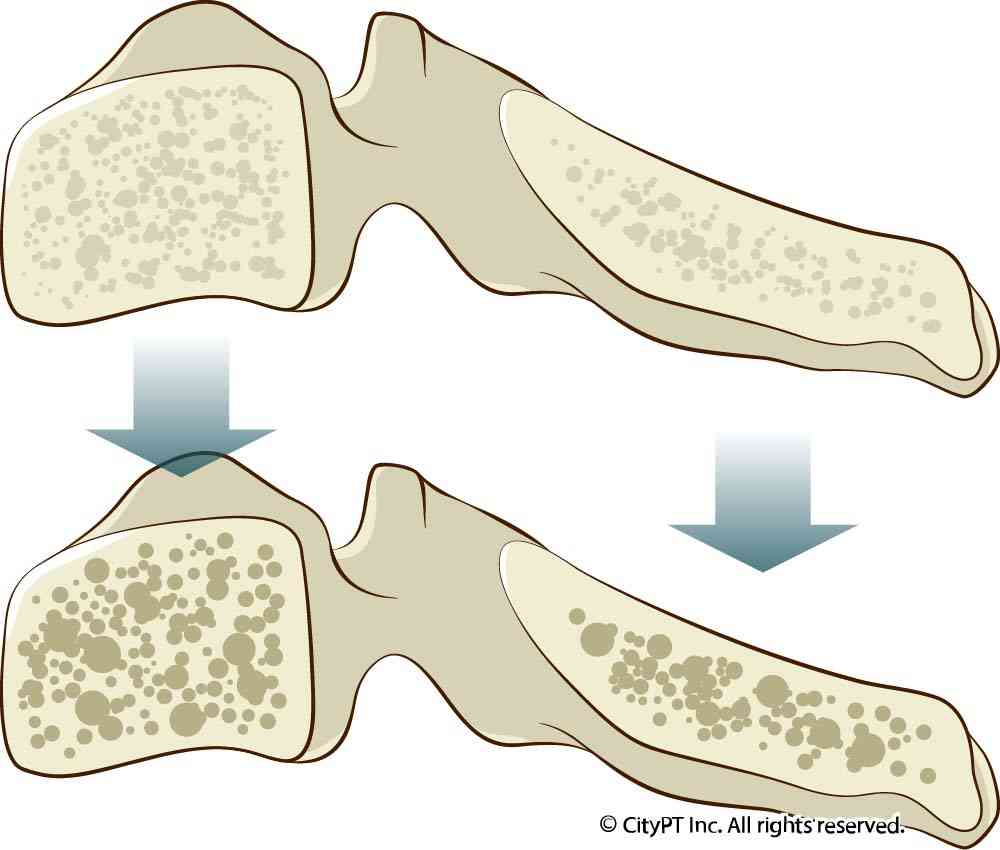 Detail of cervical osteoporosis, which is a deterioration of bone tissue in the neck Illustration of a cervical osteoporosis