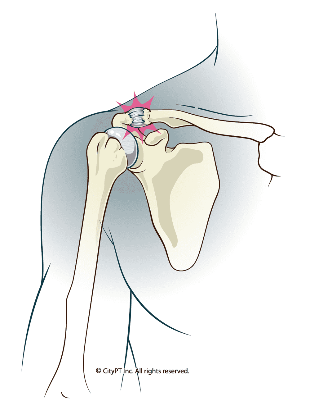 AC Joint injury, highlighting the separation of the acromioclavicular joint and the damaged ligaments Anatomical illustration of an AC Joint Injury