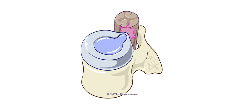 Illustration of a herniated disc