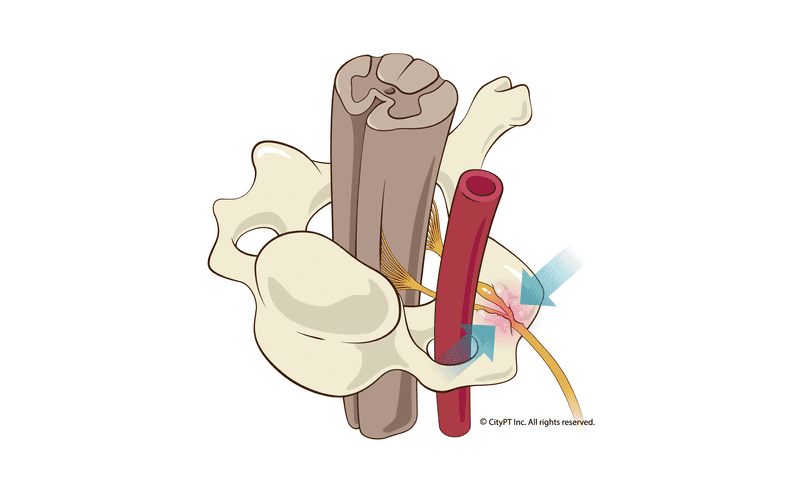 Illustration close-up of cervical radiculopathy