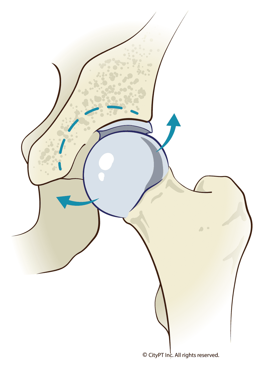 Detailed illustration of hip dysplasia