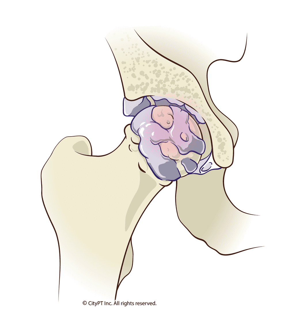 Detail of the degeneration and breakdown of the cartilage in the hip that occurs with osteoarthritis Detailed illustration of osteoarthritis in the hip