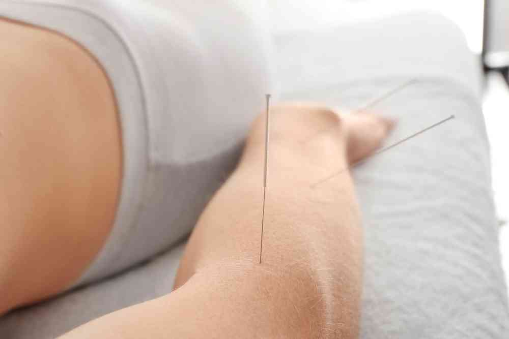 Woman with dry needles inserted into her arm