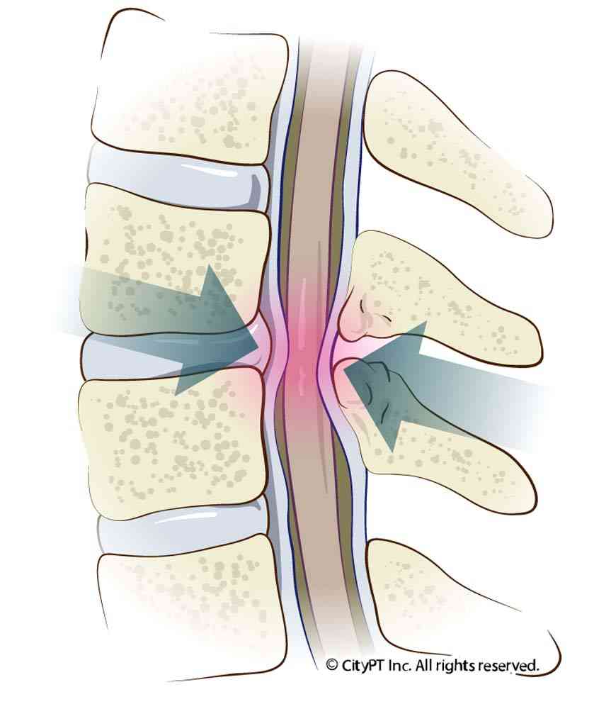 Illustration of the cervical stenosis