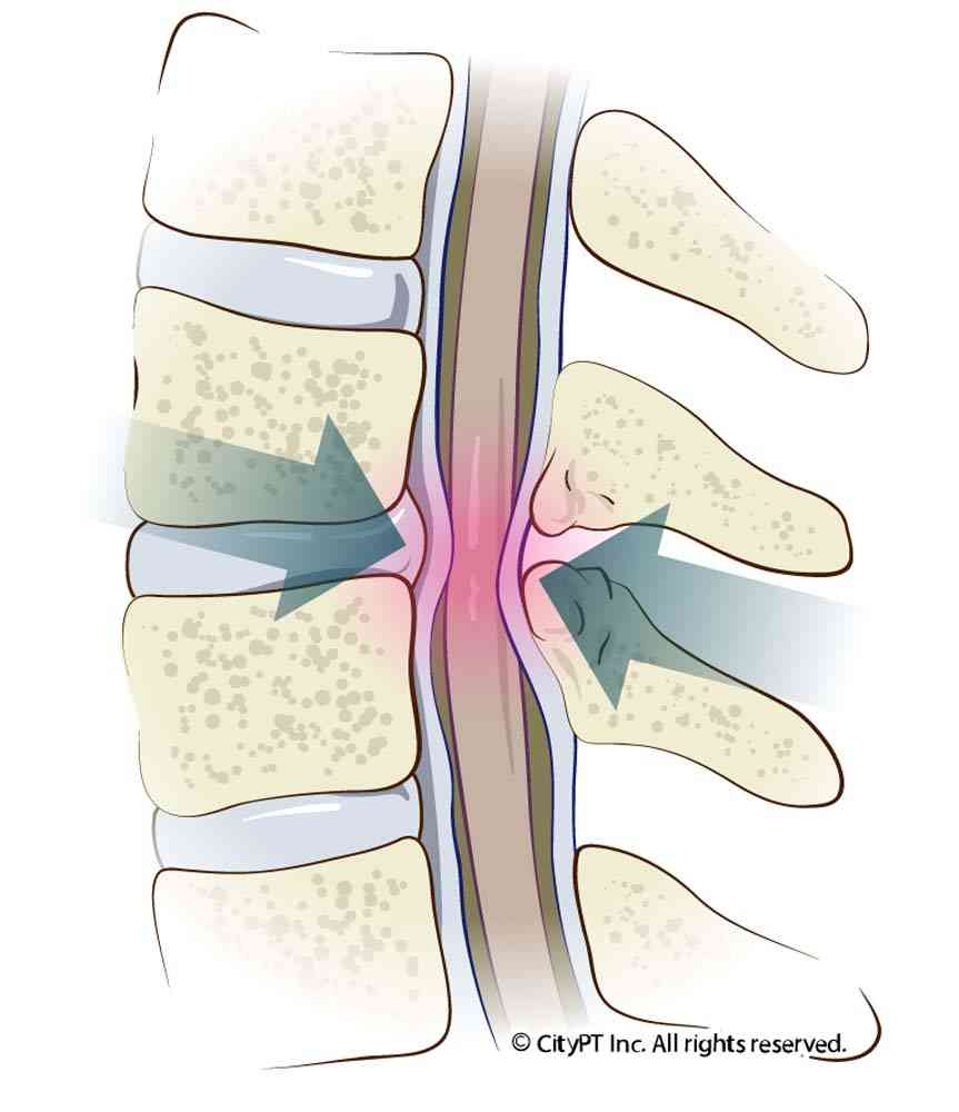 Detail of cervical stenosis, a degenerative compression of the spinal cord and nerve roots Illustration of the cervical stenosis