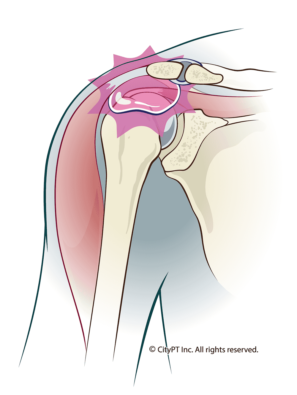Shoulder bursitis is caused by an inflamed bursa, a fluid-filled sac between the bones and soft tissue Illustration of shoulder bursitis anatomy