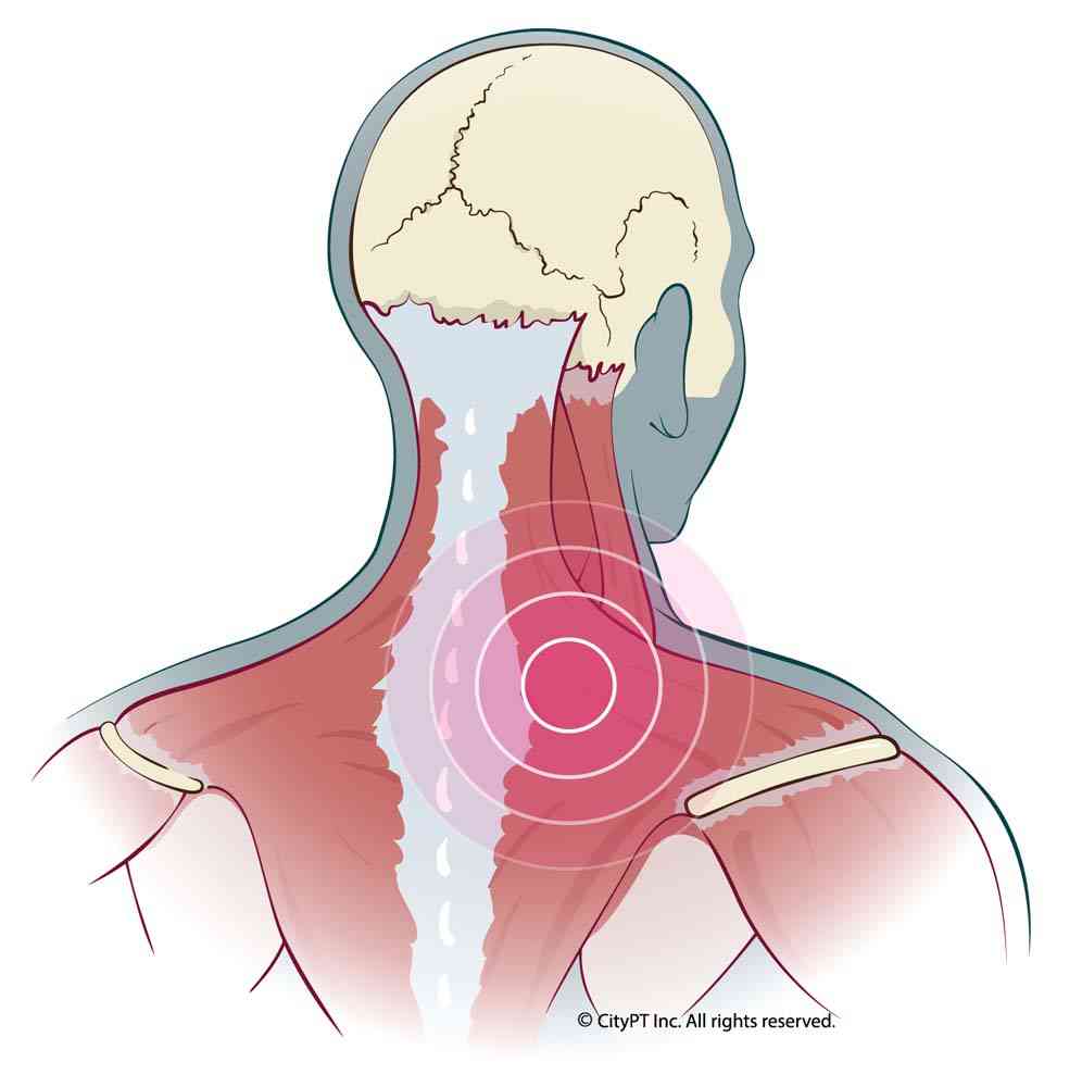 Illustration of neck muscle anatomy with myofascial pain
