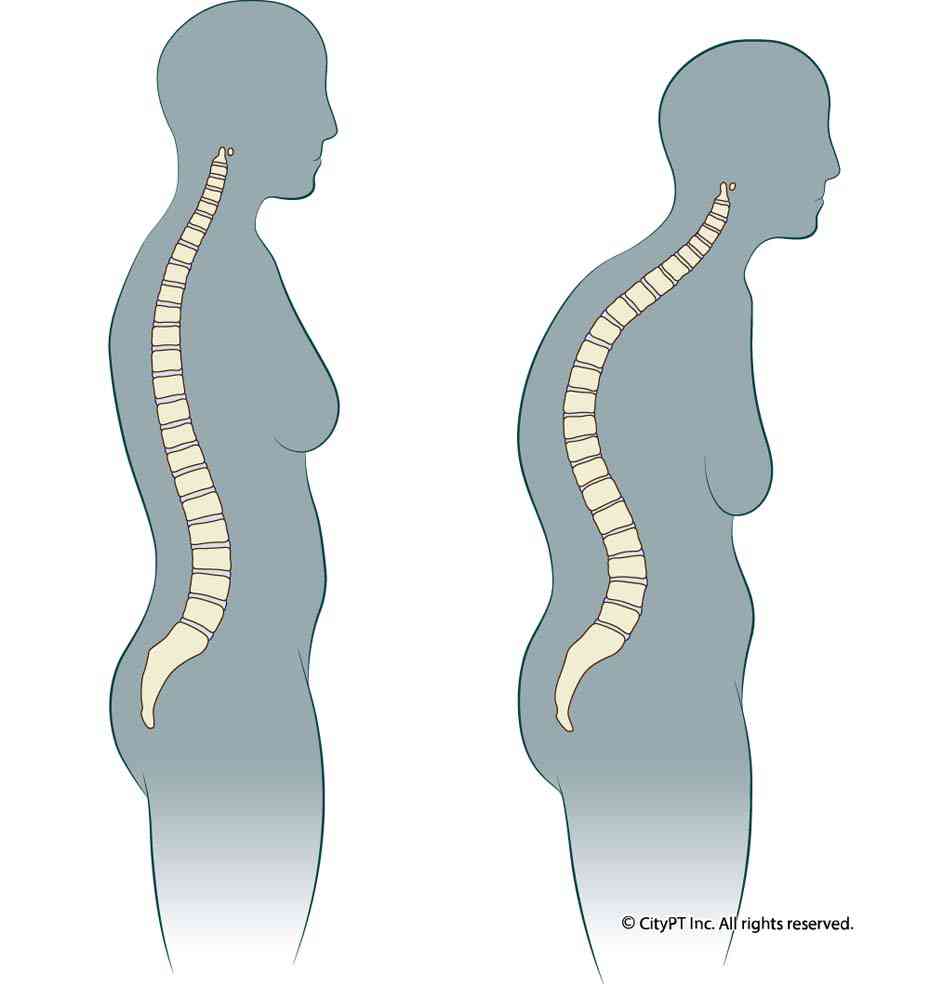 Illustration of a before and after view of a spine with hyperkyphosis