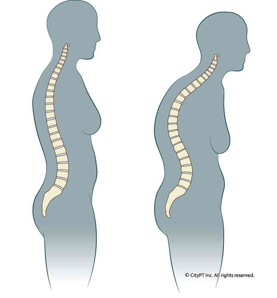 As time passes, the spine may gradually deform into an exaggerated, head-forward posture Illustration of a before and after view of a spine with hyperkyphosis