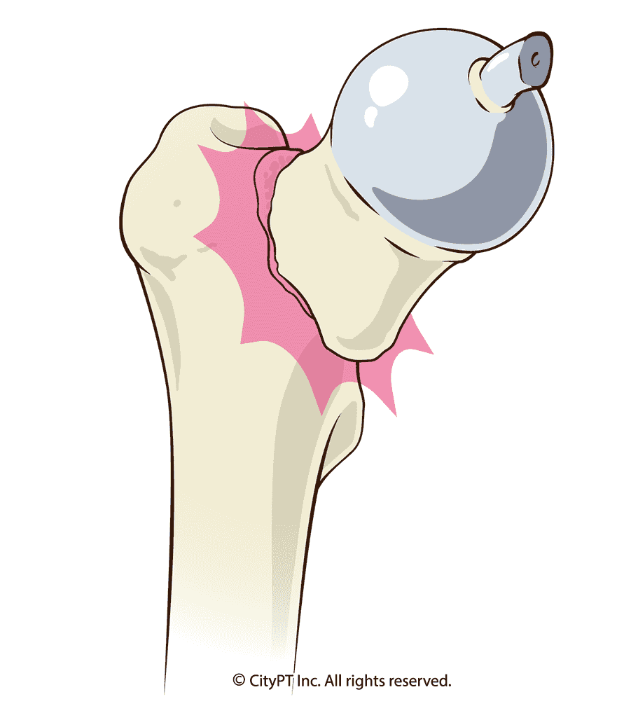 Detailed illustration of the anatomy of a broken hip bone
