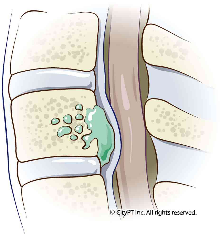 Illustration of an osteomyelitis infection