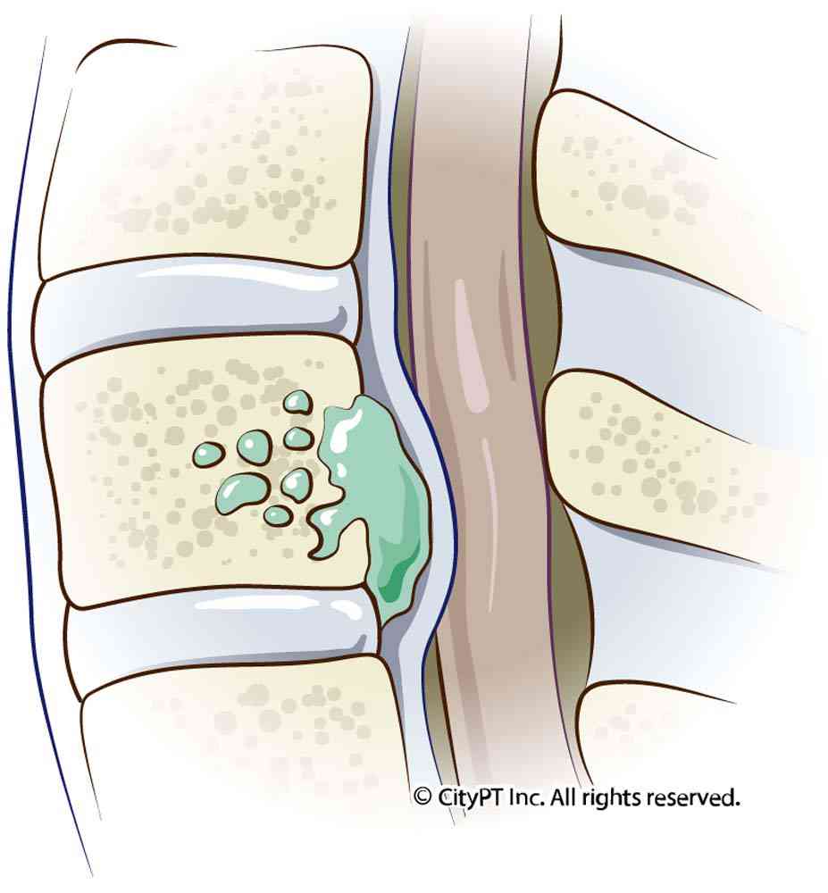 Detail of Osteomyelitis infection from bacteria or fungi invading the bone, and forming an abscess Illustration of an osteomyelitis infection