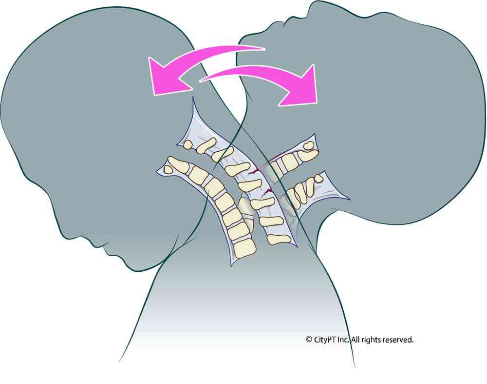 Whiplash injury may occur if the head is thrust suddenly forward and then backward Illustration of the whiplash injury occurring