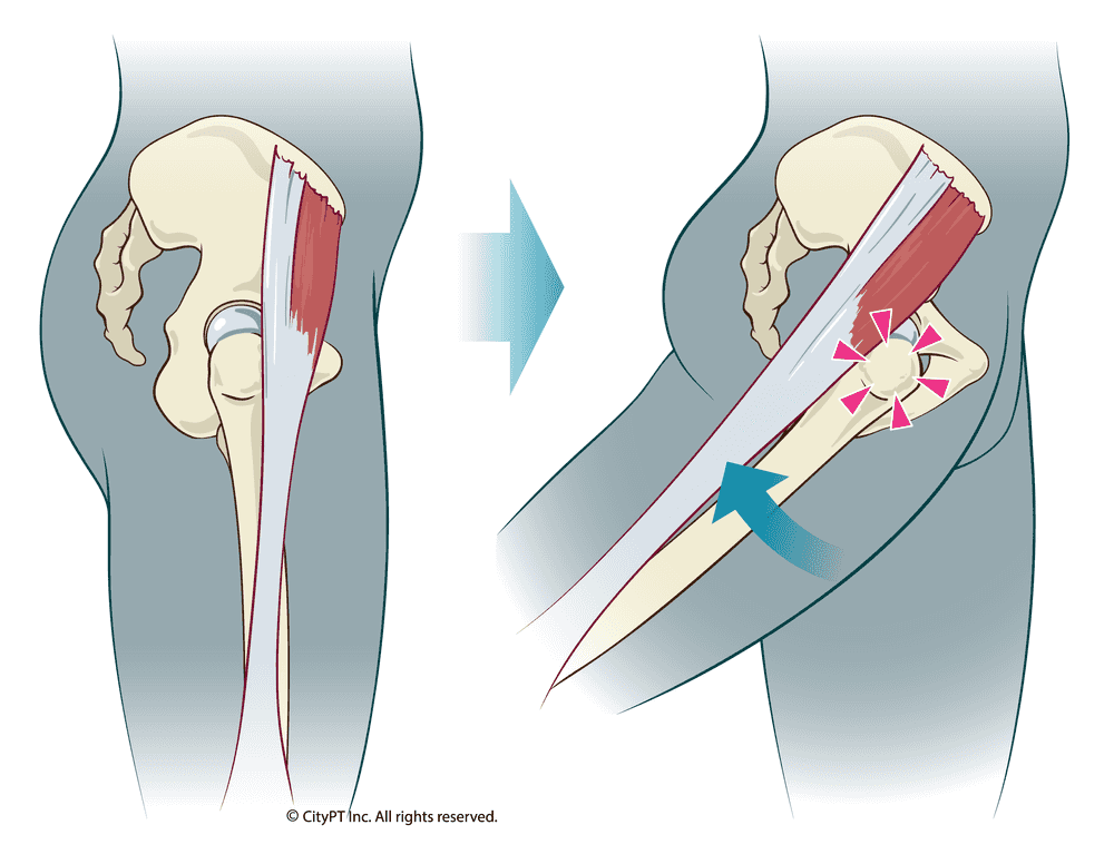 Detailed illustration snapping hip syndrome