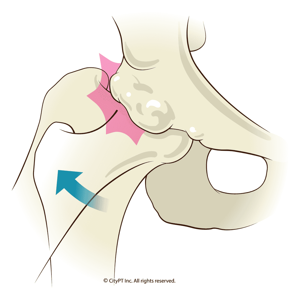 Hip impingement can lead to pain, restricted range of motion, and damage to the hip joint structures over time Detailed illustration of hip impingement anatomy