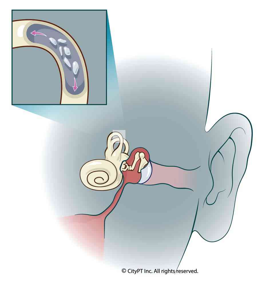 Example of vestibular and inner ear anatomy causing BPPV Illustration of vestibular and inner ear anatomy
