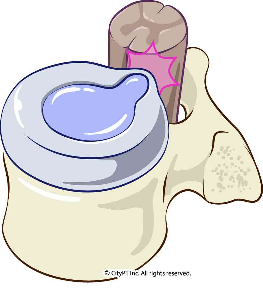 Detail of a herniated disc, where the outer layer of the disc leaks or protrudes, irritating spinal nerves Illustration of a herniated disc injury