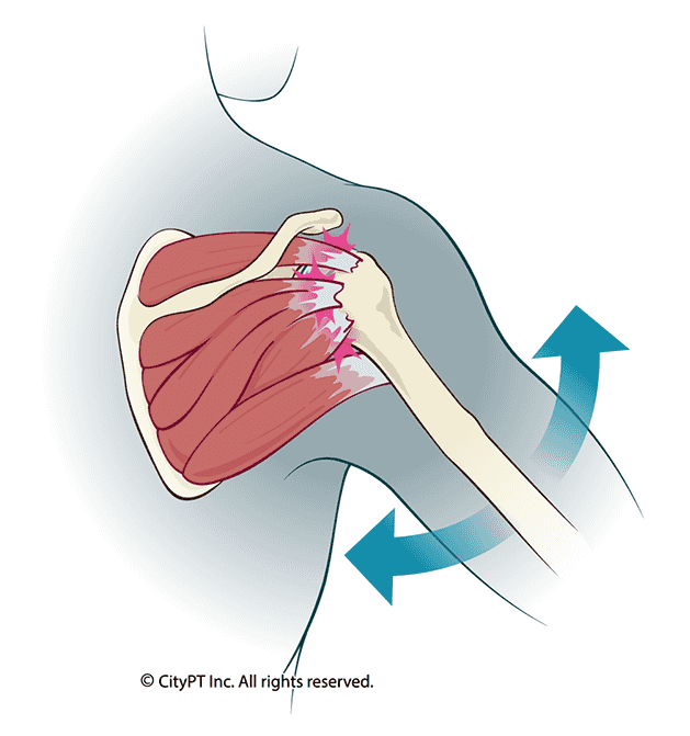 Rotator cuff tendinitis, highlighting the inflammation and irritation of the tendons surrounding the shoulder joint Anatomical illustration of rotator cuff tendinitis