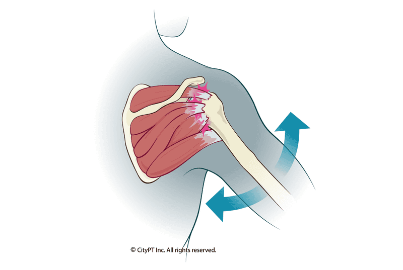 Illustration of shoulder tendinitis