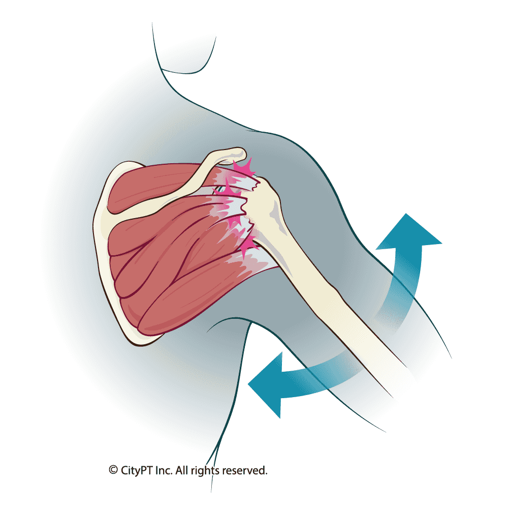 Rotator cuff tendinitis is caused by irritated tendons in your shoulder Illustration of rotator cuff tendinitis anatomy
