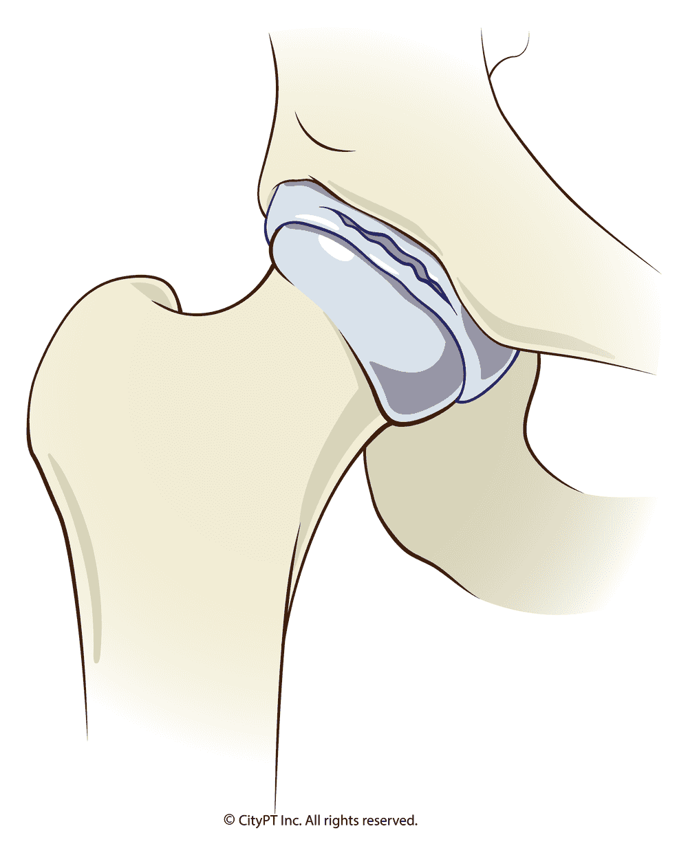 Detailed illustration of a torn labrum