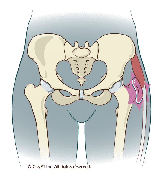 Detailed illustration an inflamed bursa in the hip