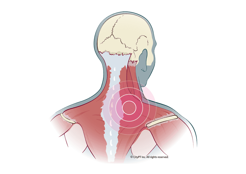 Illustration of myfascial pain