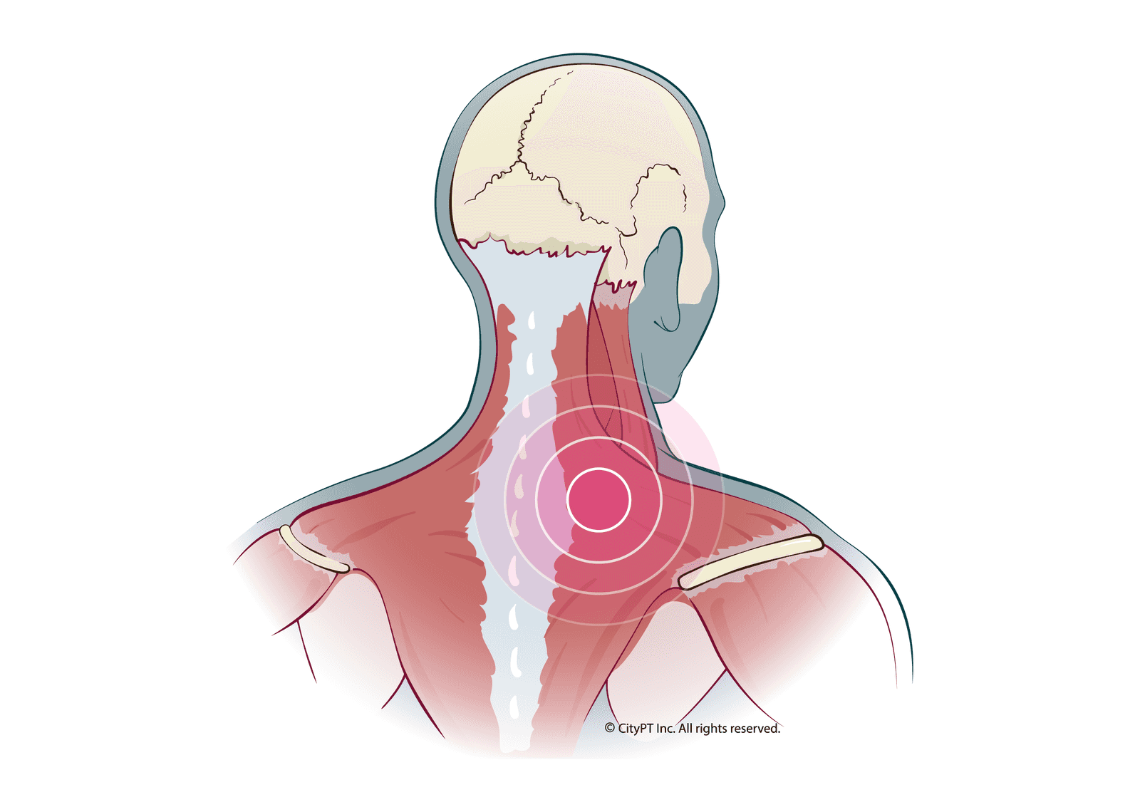 a-guide-to-physical-therapy-for-trigger-points-citypt