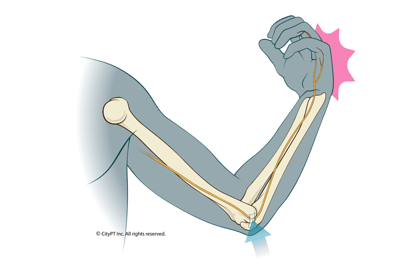 Illustration of cubital tunnel syndrome